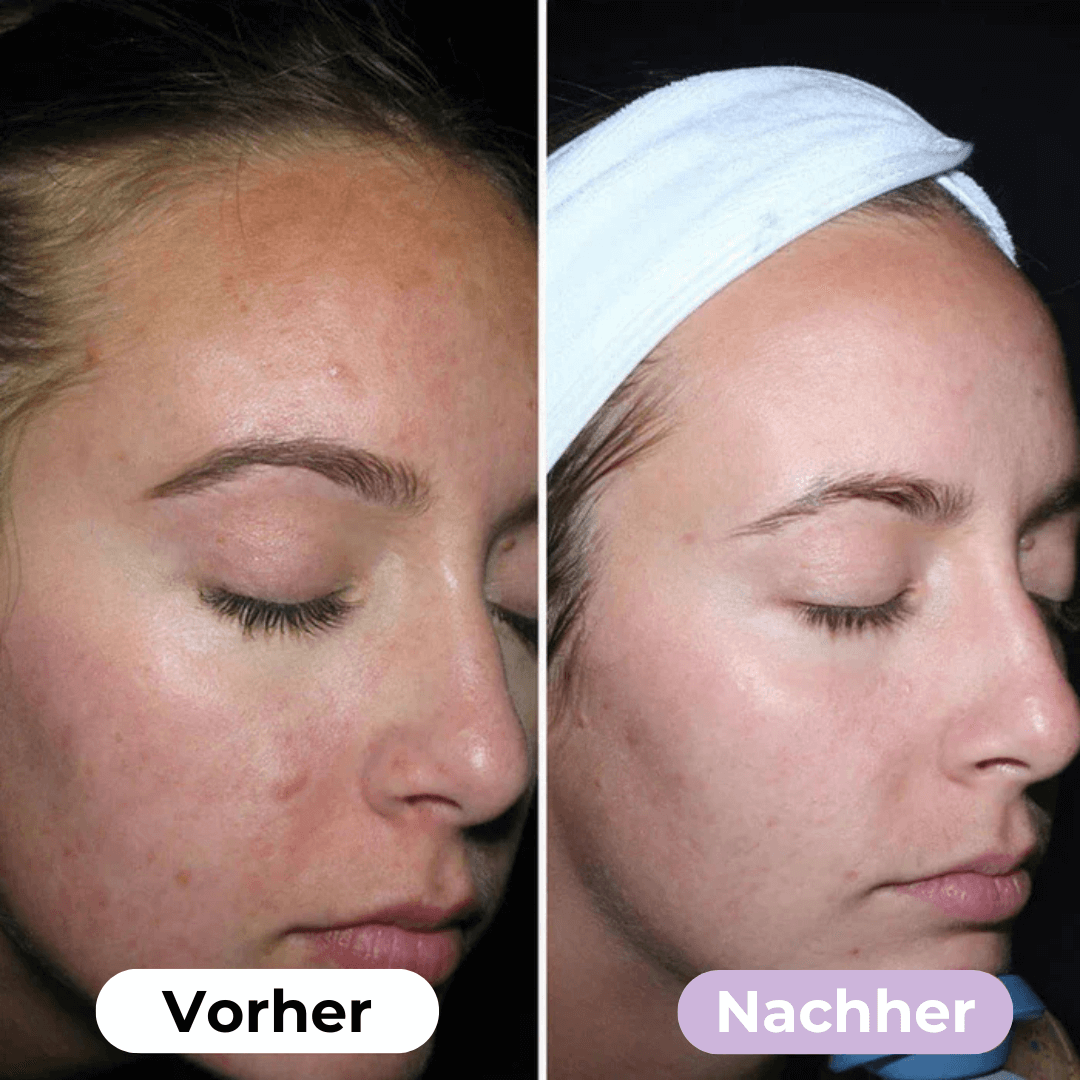 Silikon-Narbenpflaster